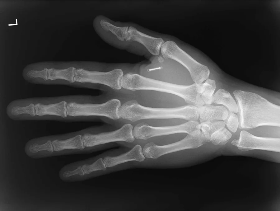 RFID-Chip implantiert